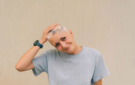 Real,Alopecia,Areata,In,A,Young,Girl.,A,Bald,Head